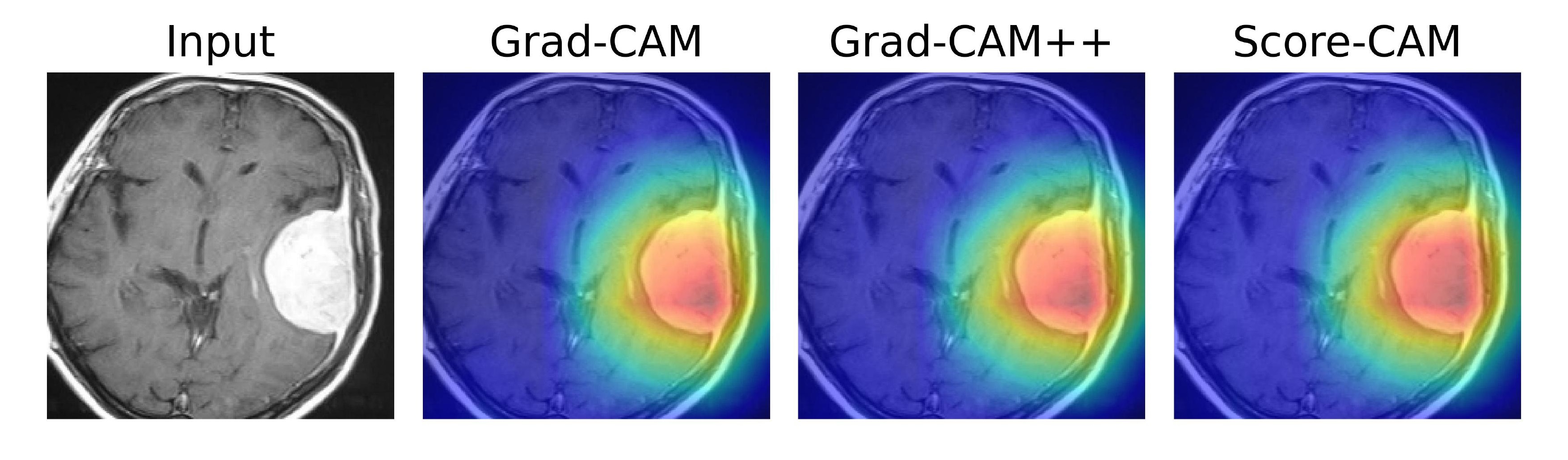 Meningioma